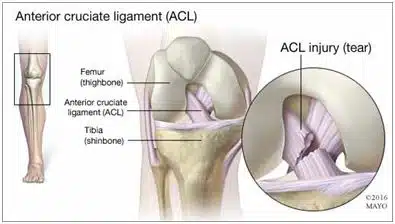 ACL injury assessment and rehabilitation with physiotherapy Illustration showing anterior cruciate ligament injury in the knee joint