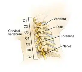 Neck pain assessment and rehabilitation with physiotherapy Illustration of cervical spine showing nerves and causes of neck pain