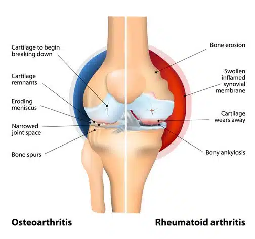Illustration showing differences between osteoarthritis and rheumatoid arthritis in the knee joint